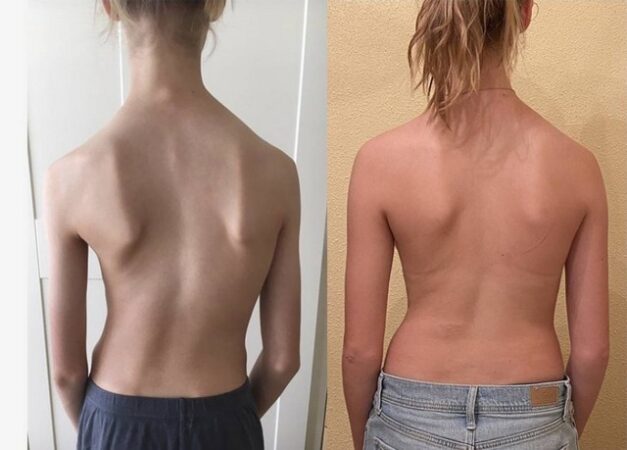 เตือนภัยซ่อนเร้น กระดูกสันหลังคดในเด็ก ภัยซ่อนเร้น ในเด็กและวัยรุ่น