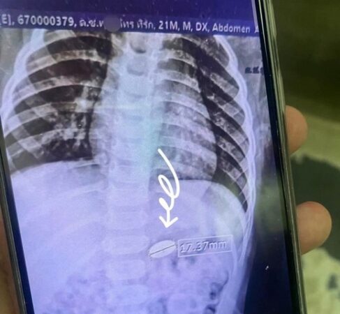 มุกดาหาร “นาทีระทึก! เด็กน้อยกลืนเหรียญ คุณแม่โพสต์สุดสะเทือนใจ ‘บทเรียนชีวิตอันยิ่งใหญ่’”