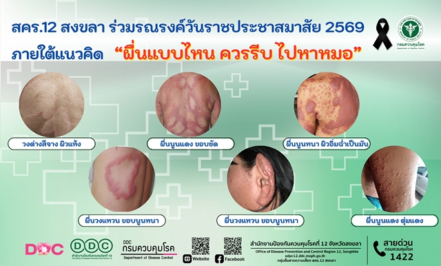สคร.12 สงขลา ร่วมรณรงค์วันราชประชาสมาสัย 2569 ภายใต้แนวคิด “ผื่นแบบไหน ควรรีบ ไปหาหมอ”